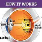 Британские врачи имплантируют первые перманентные бионические глаза