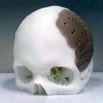 Мужчине заменили кости черепа на распечатанные… на 3D-принтере